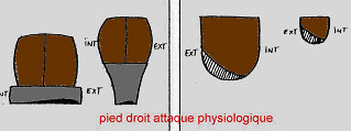 usure talon chaussure